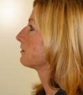 Feel Beautiful - Necklift San Diego Case 13 - After Photo